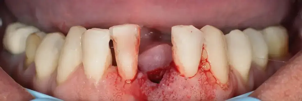 Natural oral care and gum protocol